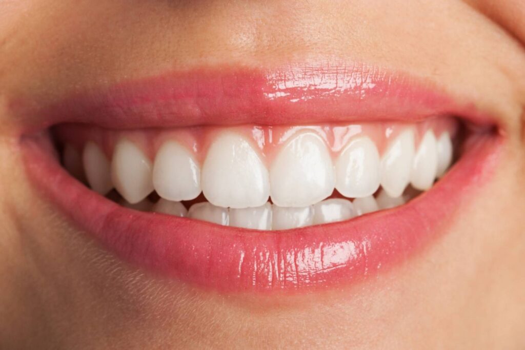 Lente de Contato Dental Juiz de Fora